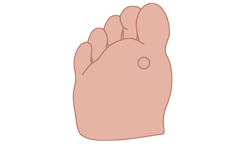Wart treatment